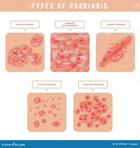 Psoriasis Types Skin Problems Close Up Medical Illustrations Vector
