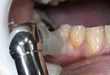 Photos of Dental Ozone Therapy Side Effects