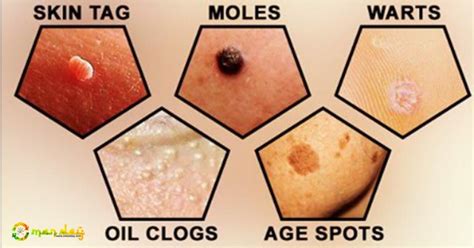 how to remove moles skin tags warts spots and blackheads easily and naturally