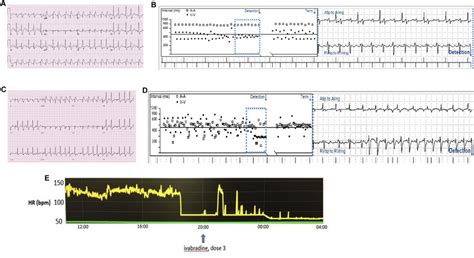A Twelve Lead Electrocardiogram Ecg Demonstrating Sinus Rhythm With