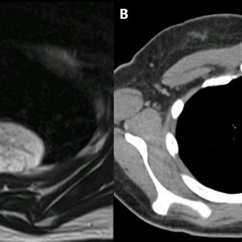 Radiographic Appearance Of An Intraosseous Hemangioma Of The Rib A