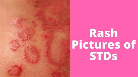 What’s This Rash Pictures Of Stds Ringworm Acne Free Face Warts On Hands