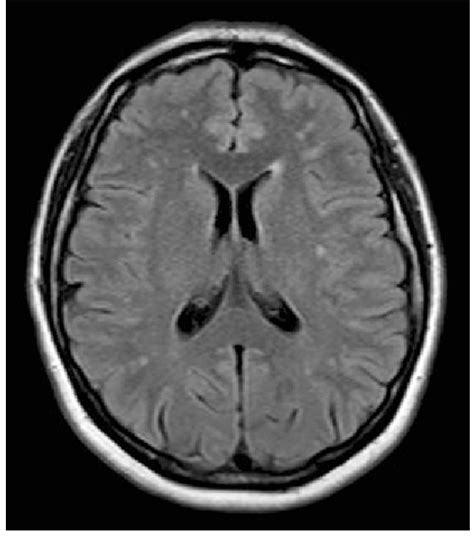 Figure 1 From Brain White Matter Lesions In Migraine Whats The