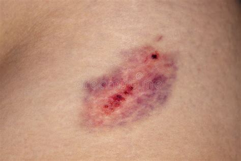 Closeup On A Bruise Or Hematoma On Waist Skin Stock Photo Image Of