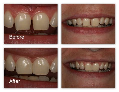 Front Teeth Fillings Restoring Smile Solution