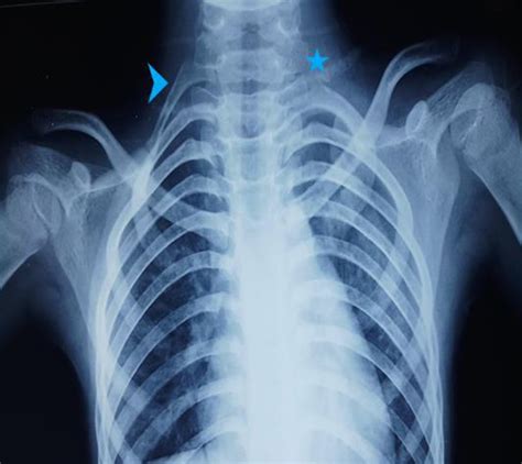 Cervical Rib A Rare Differential Of A Supraclavicular Mass Suparna