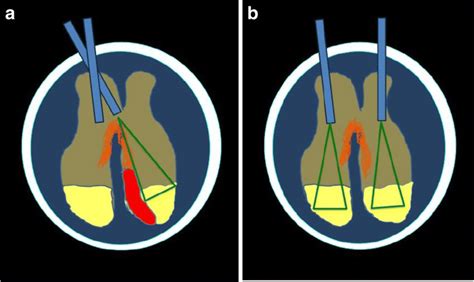Surgical Approaches A Unilateral Intraventricular Endoscopic Lavage