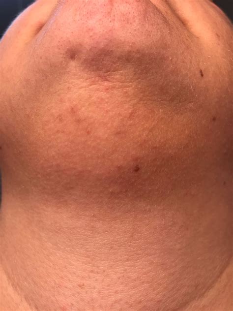 So, how can you do that? My PCOS Kitchen - Electrolysis Hair Removal - Facial Hair ...