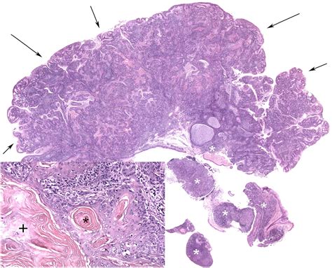 Long Term Survival In A Cat With Tonsillar Squamous Cell Carcinoma Treated With Surgery And