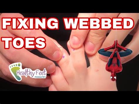 HOW TO FIX WEBBED TOES YouTube
