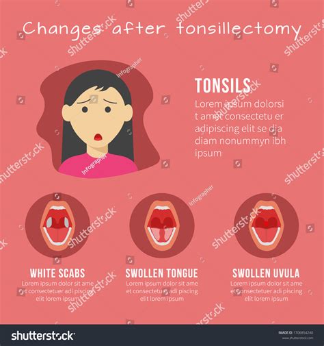 Changes After Tonsillectomy Infographic Template Stock Vector Royalty