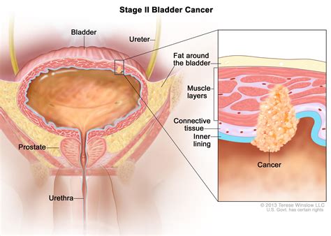 Transitional cell carcinoma affects the transitional cells. Bladder Cancer Treatment (PDQ®)-Health Professional ...