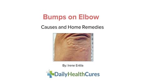 Bumps On Elbows Itchy And Non Itchy Bumps Causes Home Remedies Youtube