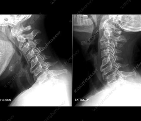 Osteoarthritis Of The Cervical Spine X Rays Stock Image C0371479