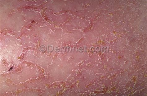 Eczema Asteatotic Photo Skin Disease Pictures