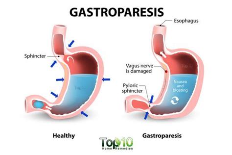 Home Remedies For Gastroparesis Top 10 Home Remedies