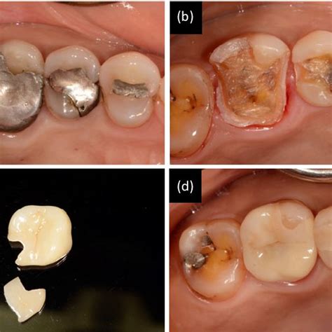 The Comparison Between The Partial Coverage Restoration And The Full