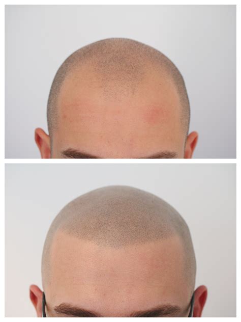 Kosten und nutzen der mittel gegen haarausfall und der haarverpflanzung vergleichen. Haartransplantation Forum : Alternativen / Ergänzungen (z ...