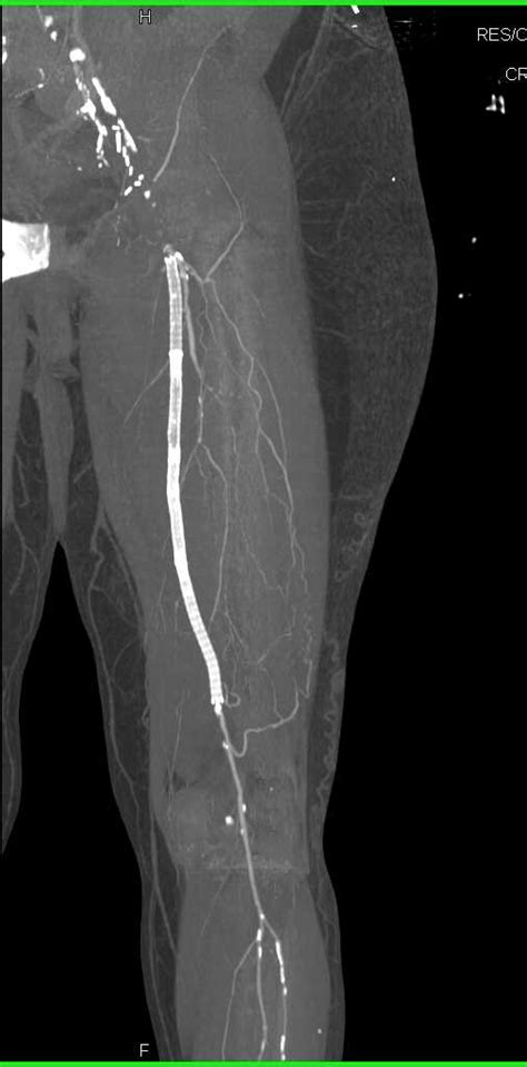 Occluded Left Femoral Artery With Stent Graft Vascular Case Studies