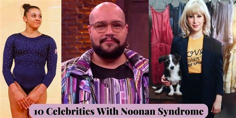 Celebrities With Noonan Syndrome