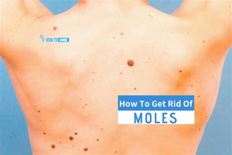 How To Get Rid Of Moles 5 Amazing Natural Remedies How To Cure