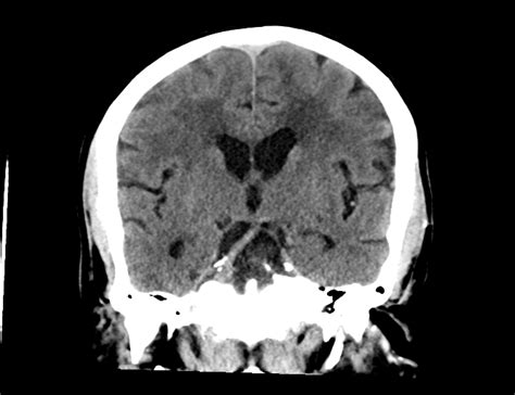 Left Cerebellar Infarct Pica Vascular Territory Image