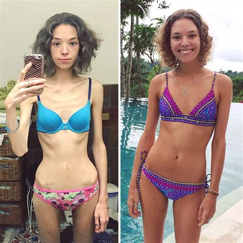 45 ‘before And After Photos Of People Who Beat Anorexia True Activist