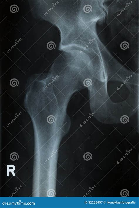 X Ray Photo Of Human Hip Royalty Free Stock Photography Image 32256457