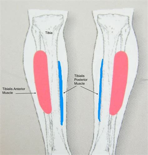 Painfreefeetca Footnotes I Have Shin Splints What Does This Mean