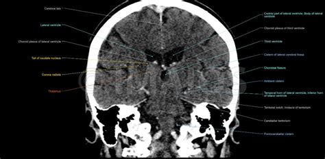 Coronal Brain Ct Lateral Ventricle Cerebral Falx Interactive