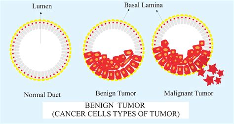 Benign Tumor