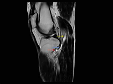 Intraneural Ganglion Cyst Of The Tibial Nerve In A Subactue Stage With