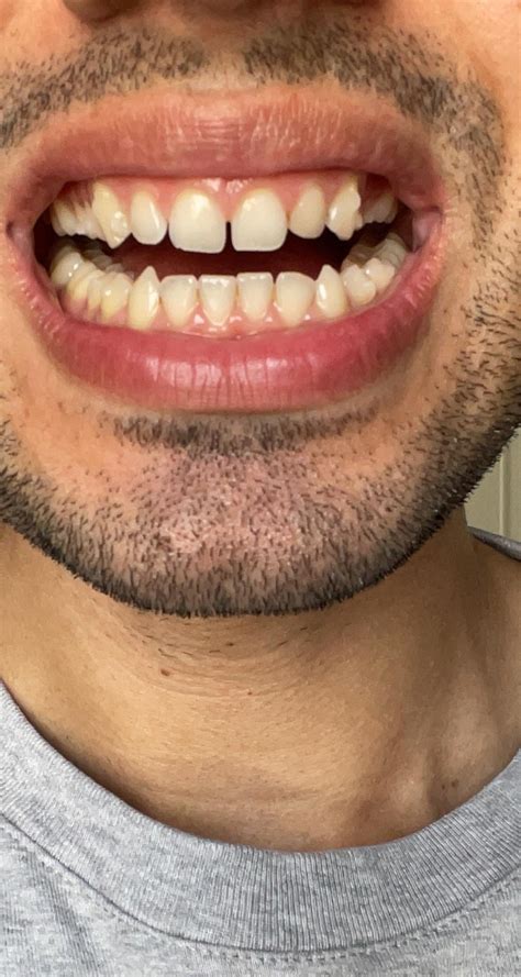 6 Months Invisalign Done And Composite Bonds Rinvisalign
