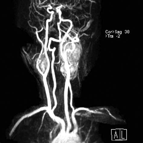 Sagittal T 1 Weighted Mri Of The Left Carotid Artery A And Right