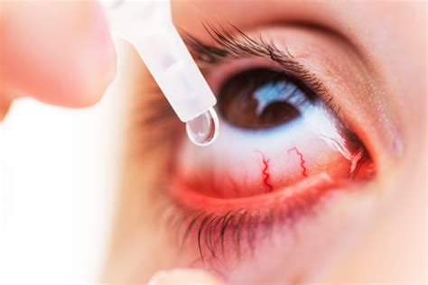 12 Obat Mata Merah Yang Ampuh Medis Dan Alami Doktersehat