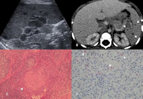 A Abdominal Sonography Demonstrating Multiple Round Hypo Echoic