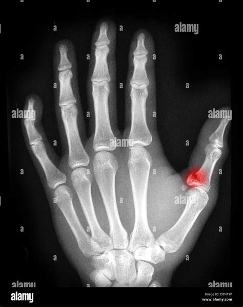 X Ray Showing An Avulsion Fracture Of The Proximal Phalanx Of The Thumb