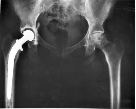 Total Hip Replacement Procedure Musculoskeletal Issues Articles
