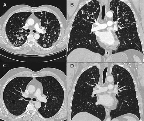 Cystic And Cavitating Lung Lesions As A Presenting Finding Of