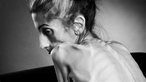 Rachael Farrokh Battles Extreme Anorexia Intervention Services Usa