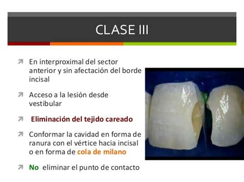 Clases De Black Odontologia
