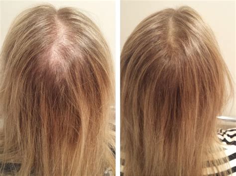 5 Ways To Hide Thinning Hair With Images Hair Loss Causes Thin