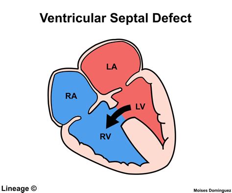 Ventricular Septal Defect Vsd Cardiovascular Medbullets Step 23