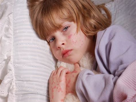 10 أمراض جلدية تصيب الأطفال احذروها مصراوى