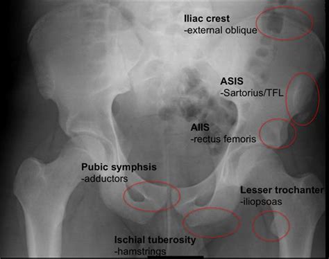 Anterior Inferior Iliac Spine Pain
