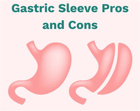 Gastric Sleeve Pros And Cons