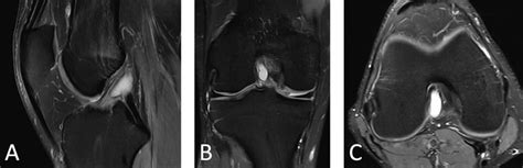 Mri Showing Acl Ganglion Cyst A Sagittal B Coronal And C Axial