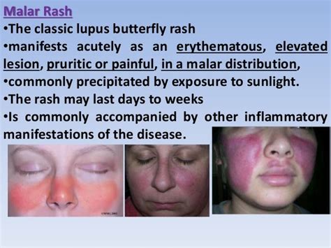 Lupus Malar Rash Vs Rosacea