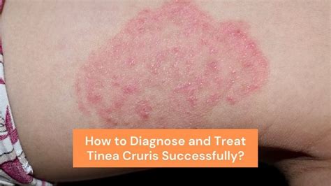 How To Diagnose And Treat Tinea Cruris Successfully