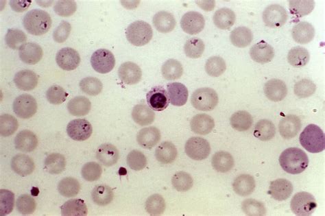 Free Picture Blood Smear Erythrocytes Developing Falciparum